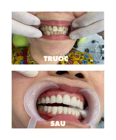 https://www.nhakhoalongtrang.com/wp-content/uploads/2022/01/12-1.png