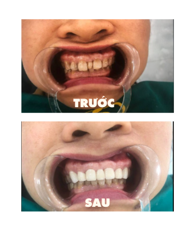 https://www.nhakhoalongtrang.com/wp-content/uploads/2022/01/4-4.png