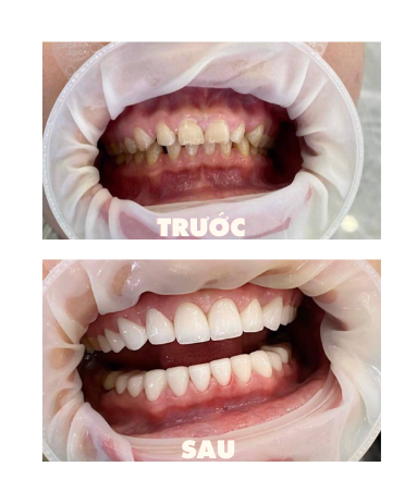 https://www.nhakhoalongtrang.com/wp-content/uploads/2022/01/7-2.png