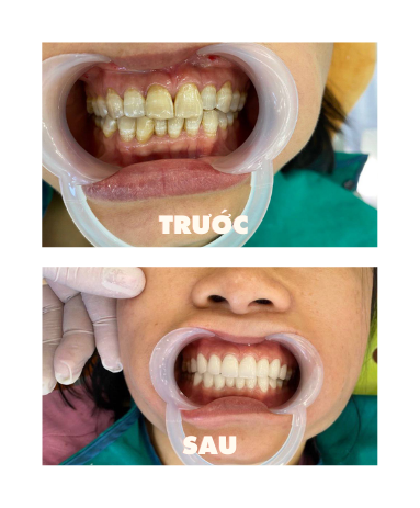 https://www.nhakhoalongtrang.com/wp-content/uploads/2022/01/8-1.png