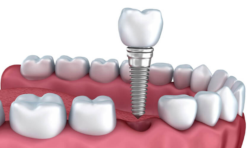 https://www.nhakhoalongtrang.com/wp-content/uploads/2022/01/trong-rang-implant-tuc-thi.jpg